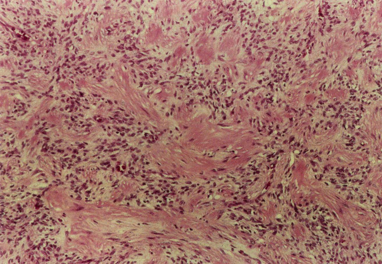 3. 隆突性皮纤维肉瘤及其纤维肉瘤亚型中的肌样/肌纤维母细胞性分化